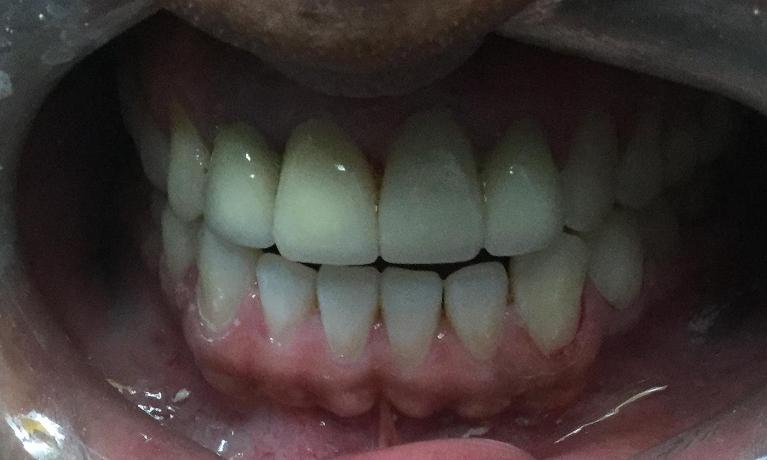 Anterior-Esthetic-open-gap-reduction-After-Image