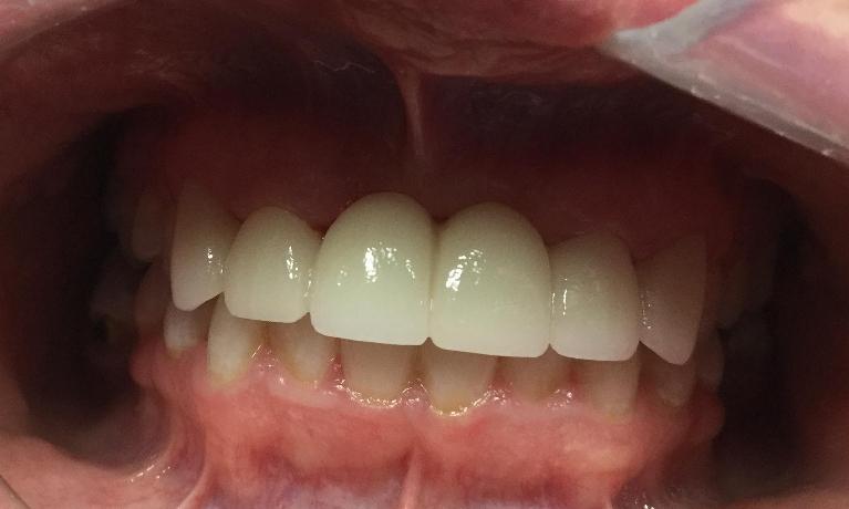 Anterior-Esthetic-Crowns-After-Image