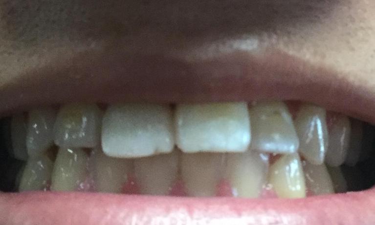 Emergency-Chipped-tooth-After-Image