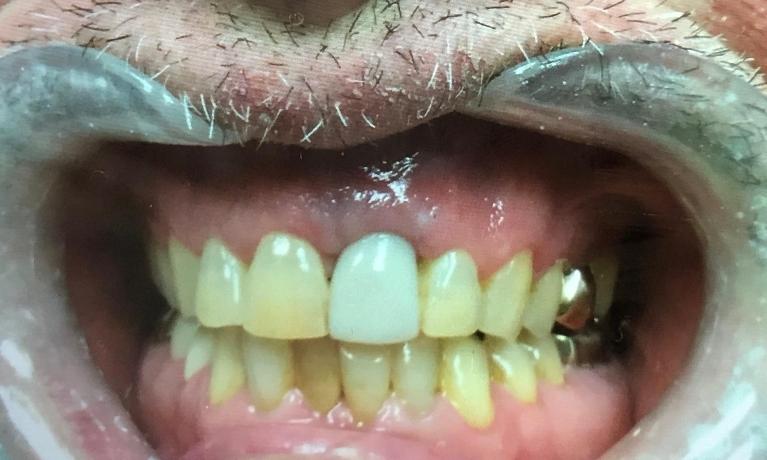 Dental-Implants-After-Image