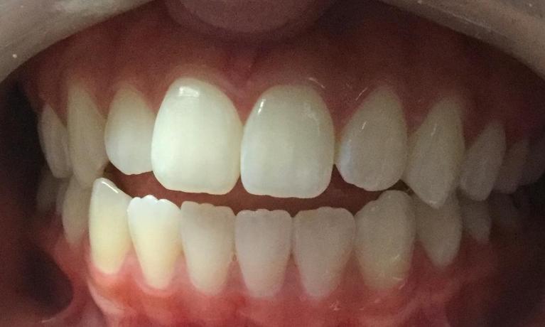 In-Office-Teeth-Whitening-After-Image