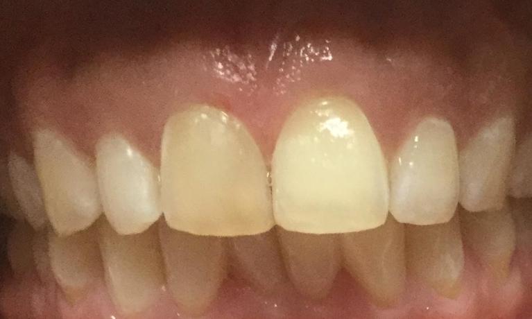 Chipped-front-teeth-After-Image