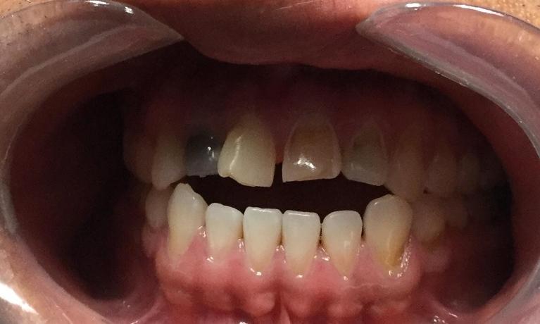 Anterior-Esthetic-open-gap-reduction-Before-Image