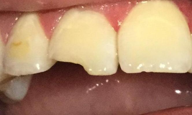 Emergency-Chipped-tooth-Before-Image