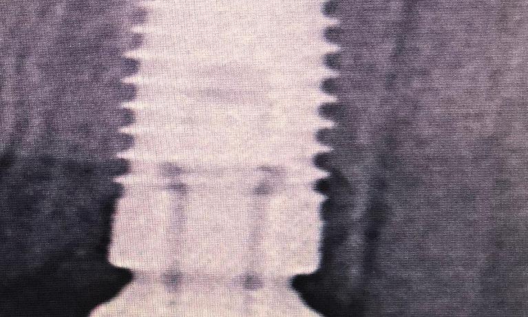 Dental-Implants-Before-Image