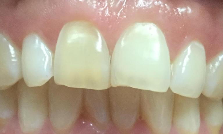 Chipped-front-teeth-Before-Image